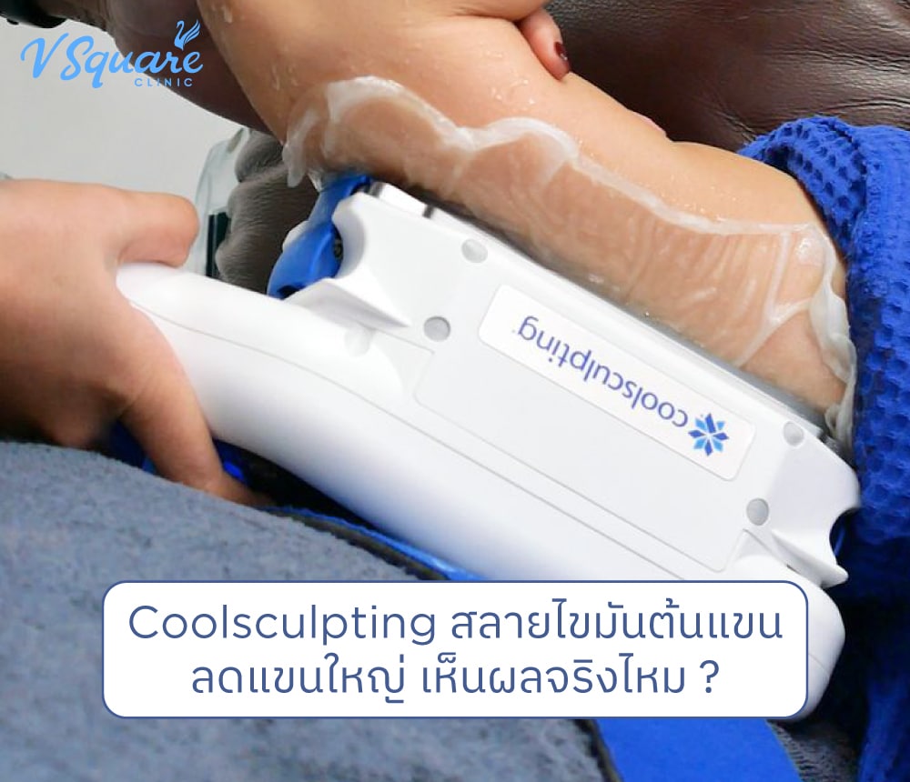 Coolsculpting สลายไขมันต้นแขน