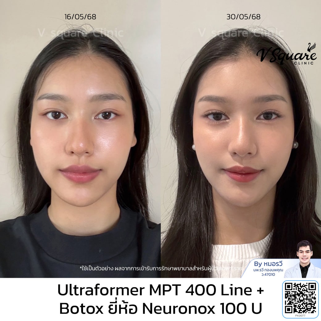 ultraformer รีวิว_ฟ้า _โดยหมอรวี