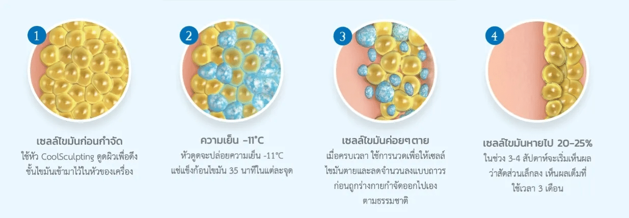 กลไกการทำงานของ Coolsculpting สลายไขมันต้นขา