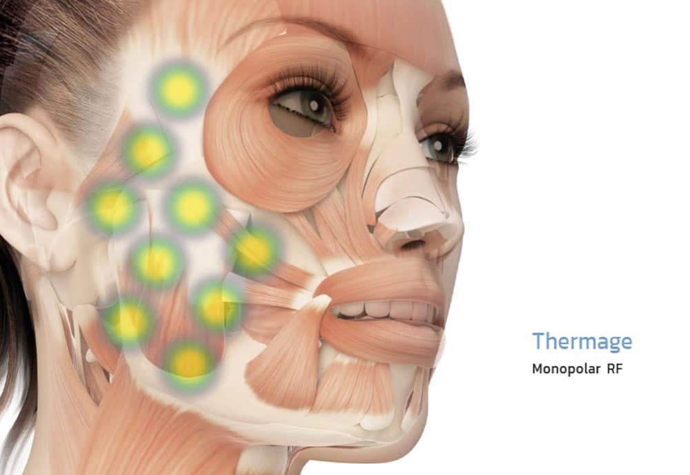 การส่งพลังงานของ thermage