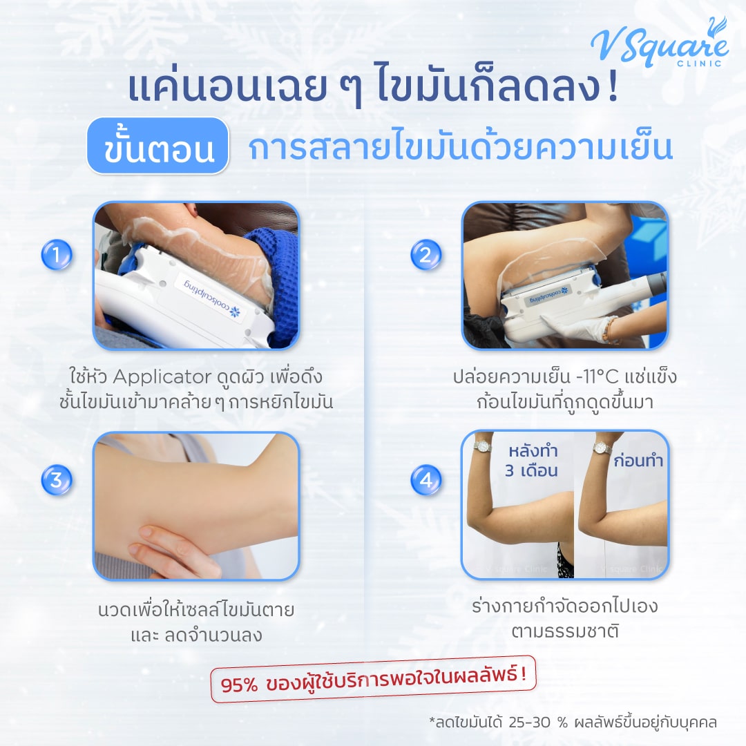 ทำ Coolsculpting ต้นแขน