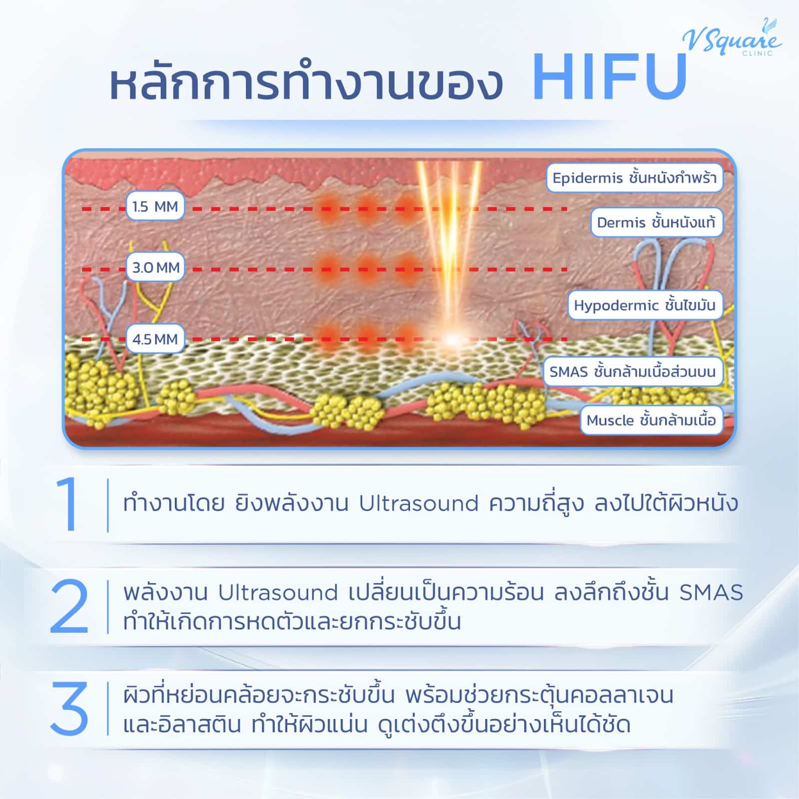 พลังงาน Ultraformer III