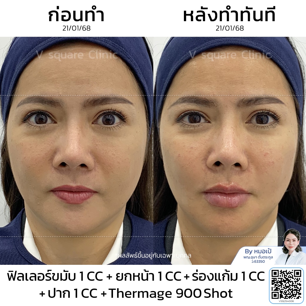 รีวิว Thermage_พี่ปุ้ย (Content โหนกระแส)_โดยหมอเป้