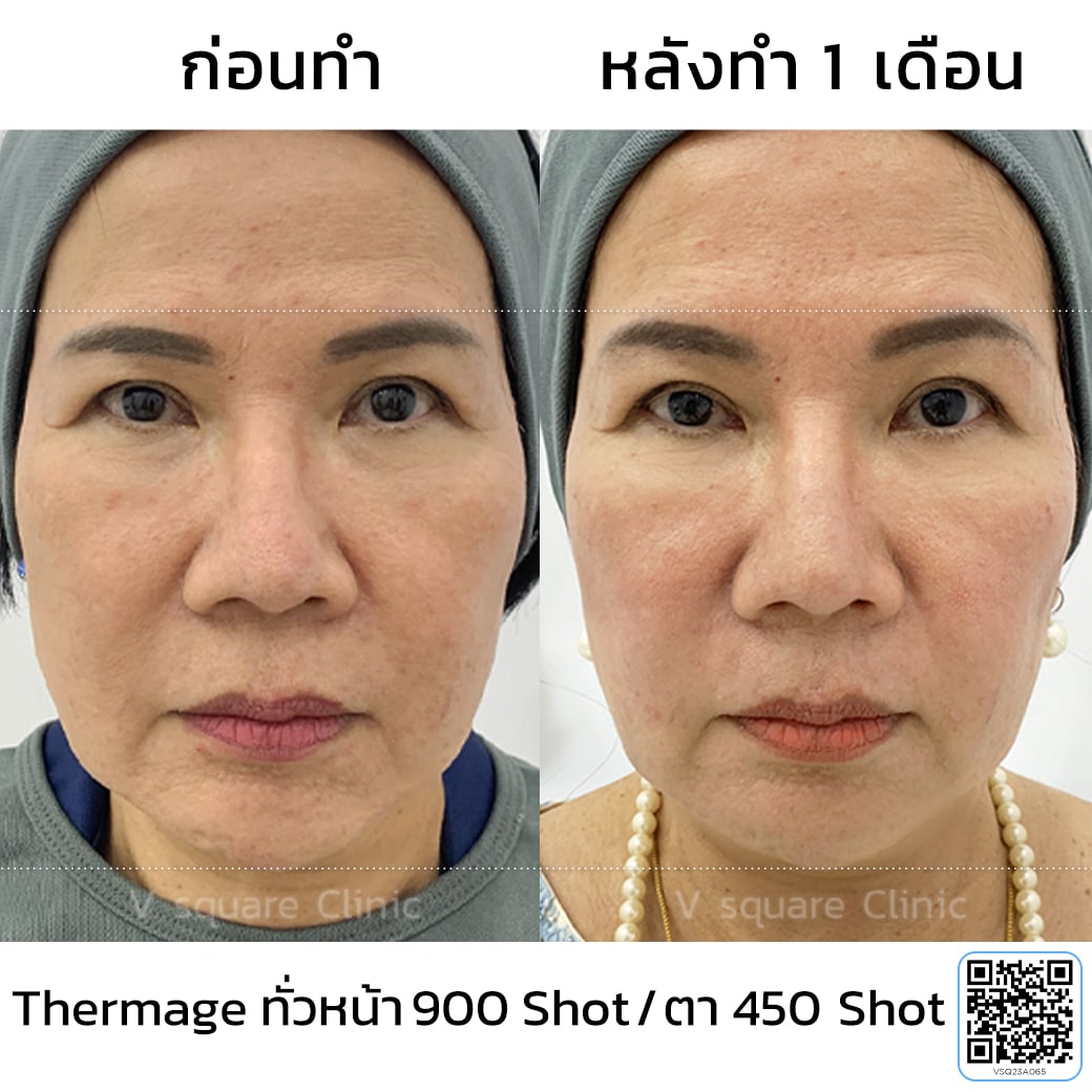 รีวิว Thermage_แม่อ๋อย