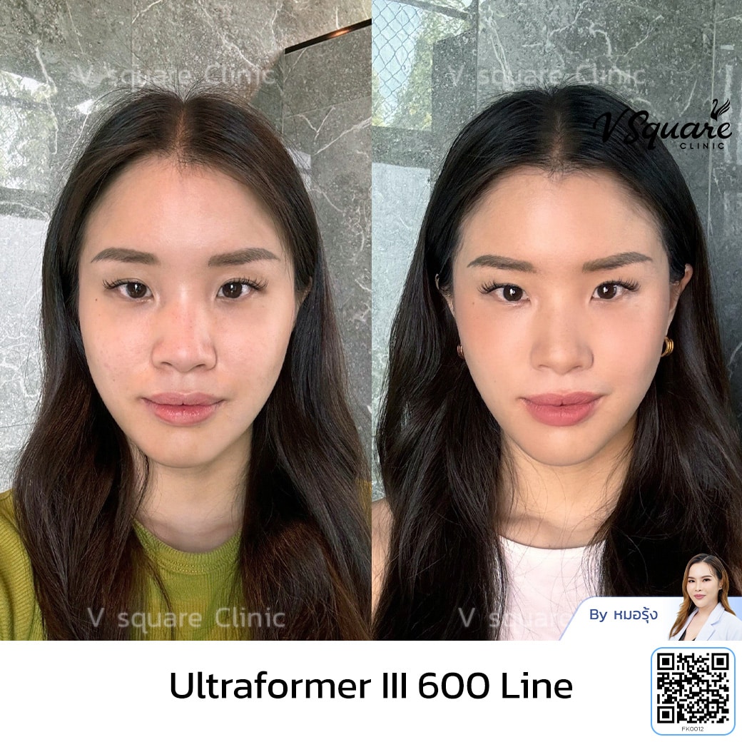 รีวิว Ultraformer III อยู่ได้นานไหม_คุณแน้น Influencer_โดยหมอรุ้ง