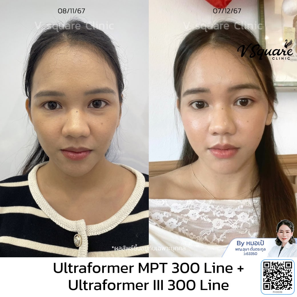 รีวิว Ultraformer III อยู่ได้นานไหม_มายด์ (นักกายทำ)_โดยหมอเป้