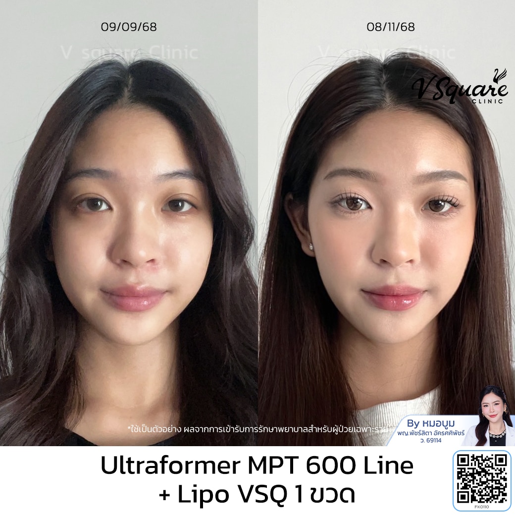 รีวิว ultraformer _คุณเอมี่ FK _โดยหมอบูม