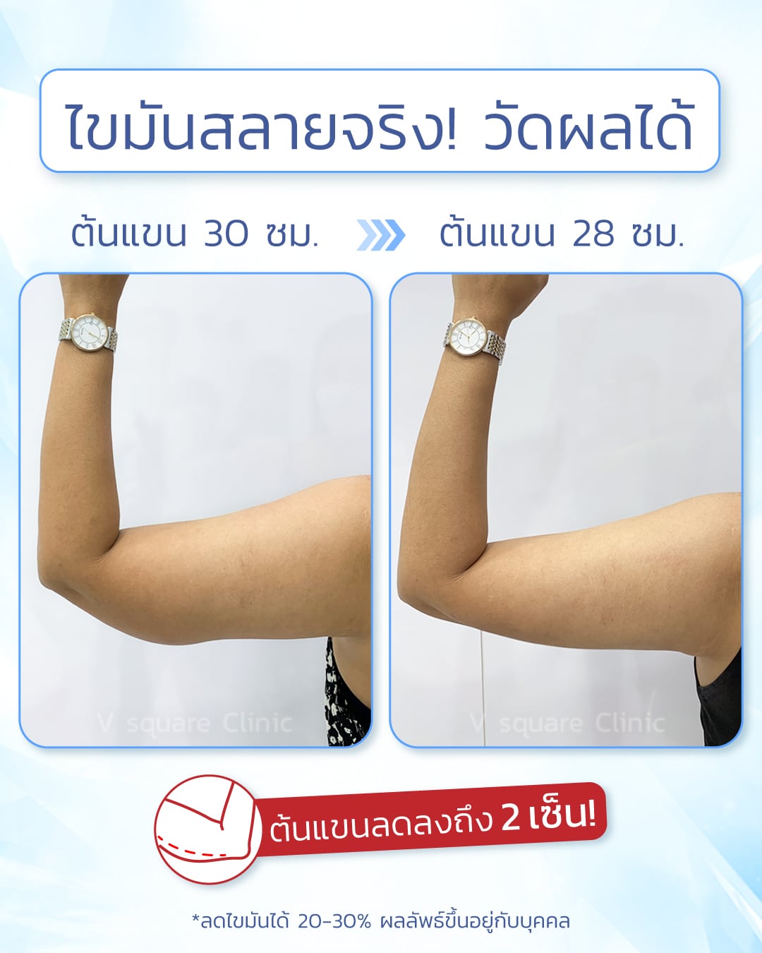 รีวิวผลลัพธ์หลังทำ Coolsculpting