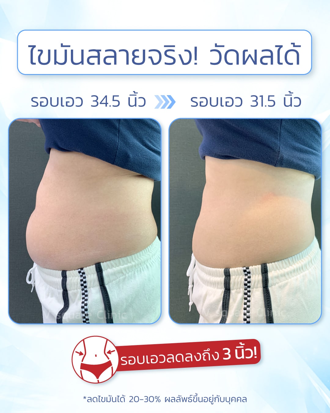 รีวิวผลลัพธ์หลังทำ Coolsculpting