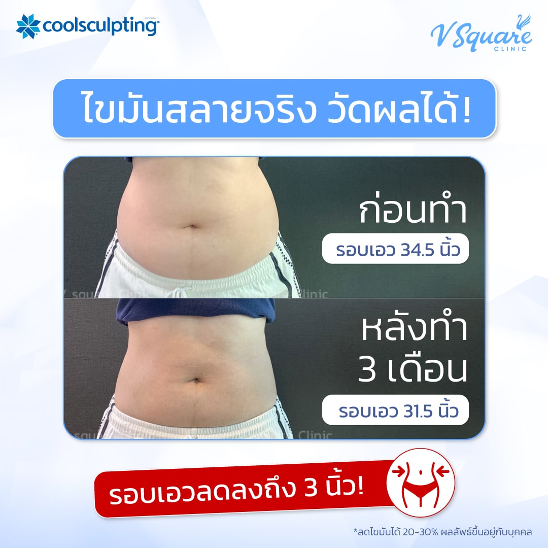 รีวิวผลลัพธ์หลังทำ Coolsculpting